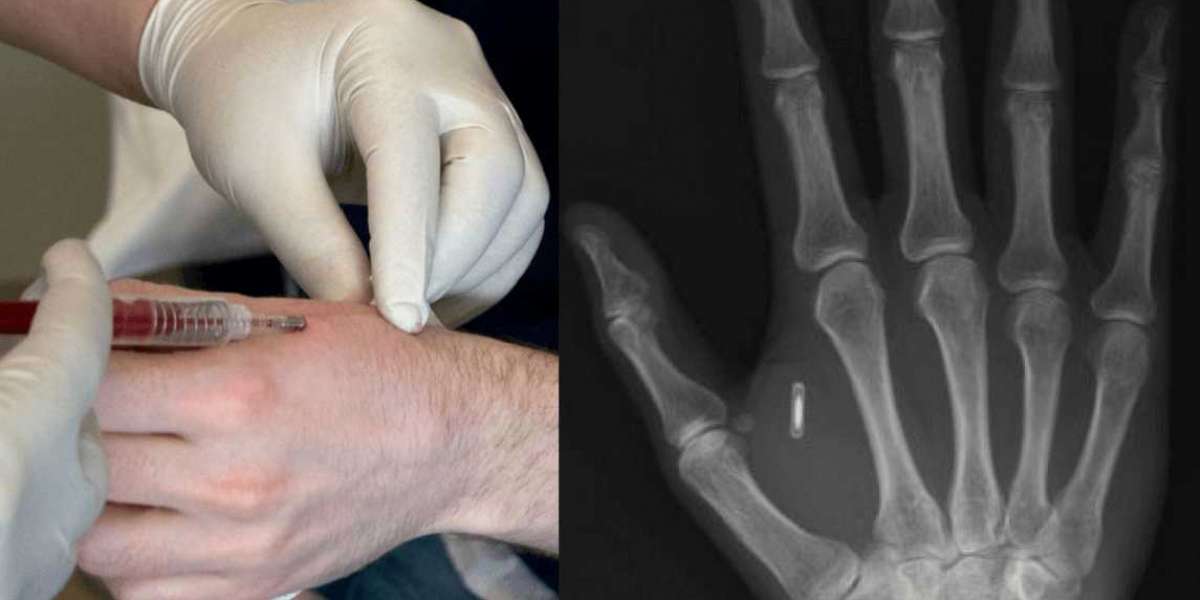 A história de como um bio-chip foi implantado em meu corpo